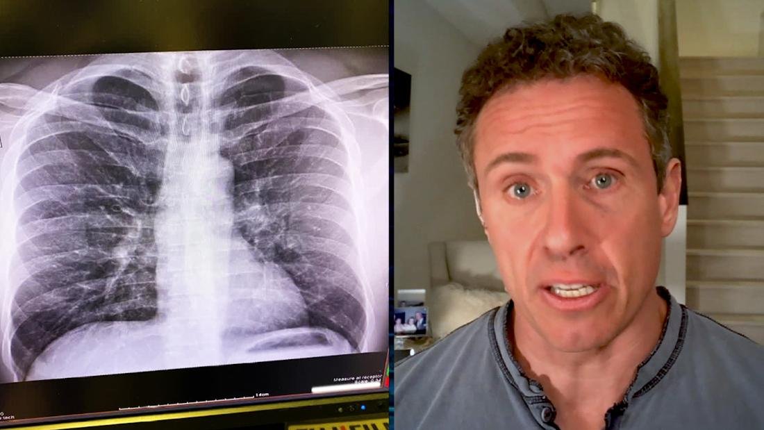 Chris Cuomo shares chest X-rays after coronavirus diagnosis