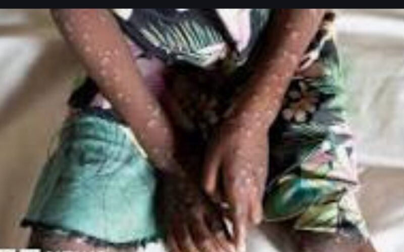 Abia State Confirms First Case of Monkeypox