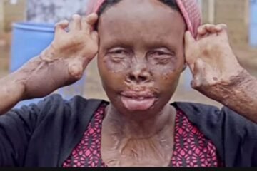 Nigerian Woman narrates why husband sent her ablaze in public, ran away