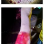 A gored arm.