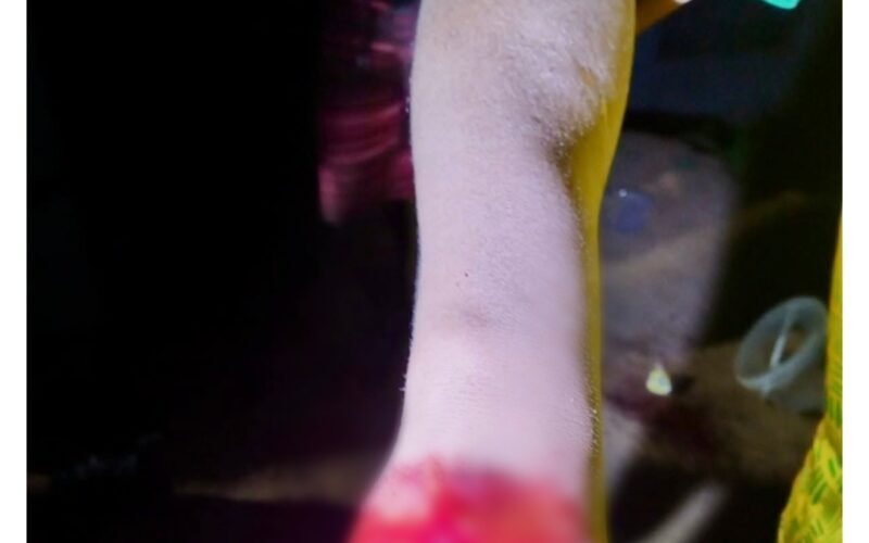 A gored arm.